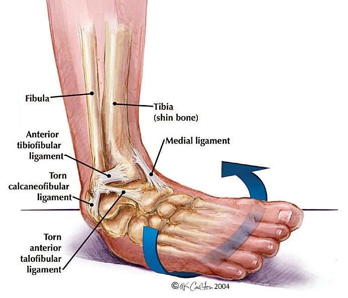This is the most common type of ankle sprain, with over 70% of sprains belonging to this category. They involve commonly 2 ligaments on the outer part of the ankle: Anterior talofibular ligament (ATFL) and Calcaneofibular ligament (CFL). When a person rolls their foot inwards, the outer ligaments become torn, especially the ATFL which is known to be the primary stabilising ligament of the ankle joint.