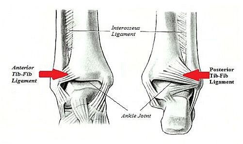 Syndesmotic Sprain (High Ankle Sprain)