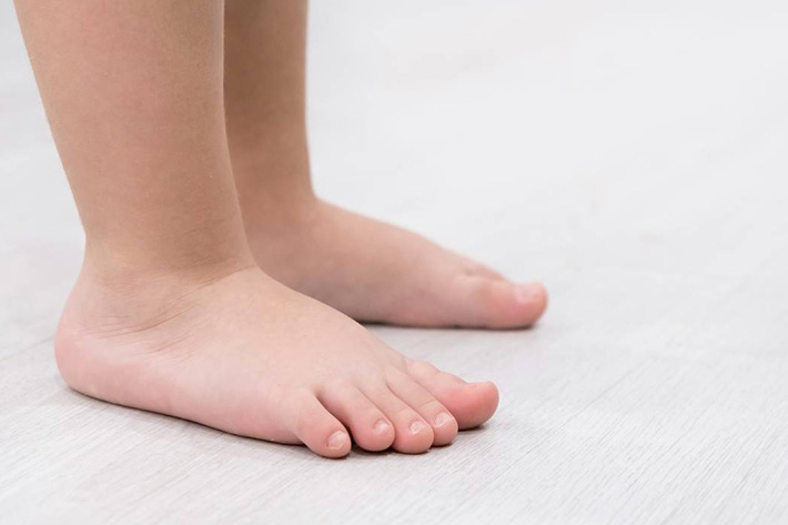 Pediatric Flat Foot