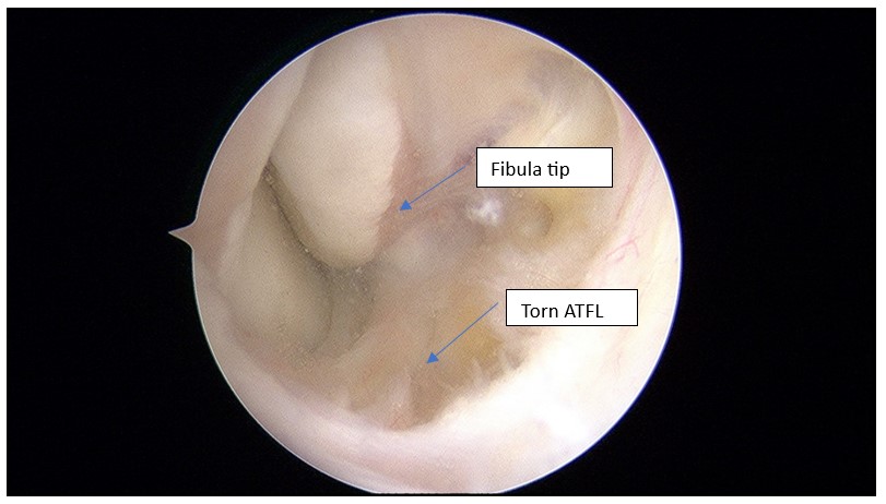 Arthroscopy image of a torn ATFL supposed to be attached to the fibula tip. Note the looseness.