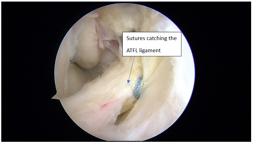 Using a specialised technique, sutures are placed on the torn ligament. A small channel is made in the fibula tip and using a 3 mm thick implant screw , the ligament is reanchored to the bone via the implant