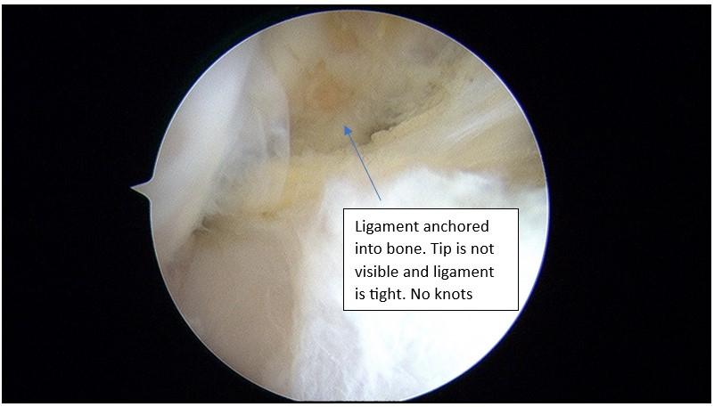 Recovery time for ankle sprains varies depending on the severity of the injury.